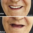 Befor-After-پروتز-دنداندندان-مصنوعیدندانسازی-لبخند-بندرعباس